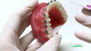 interproximal